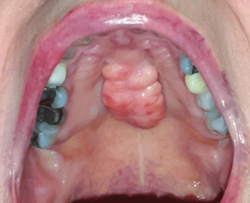 Mouth Lump on Roof of Mouth