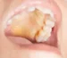 Yellow Roof of Mouth Causes, Symptoms, and When to See a Doctor