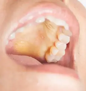 Yellow Roof of Mouth Causes, Symptoms, and When to See a Doctor
